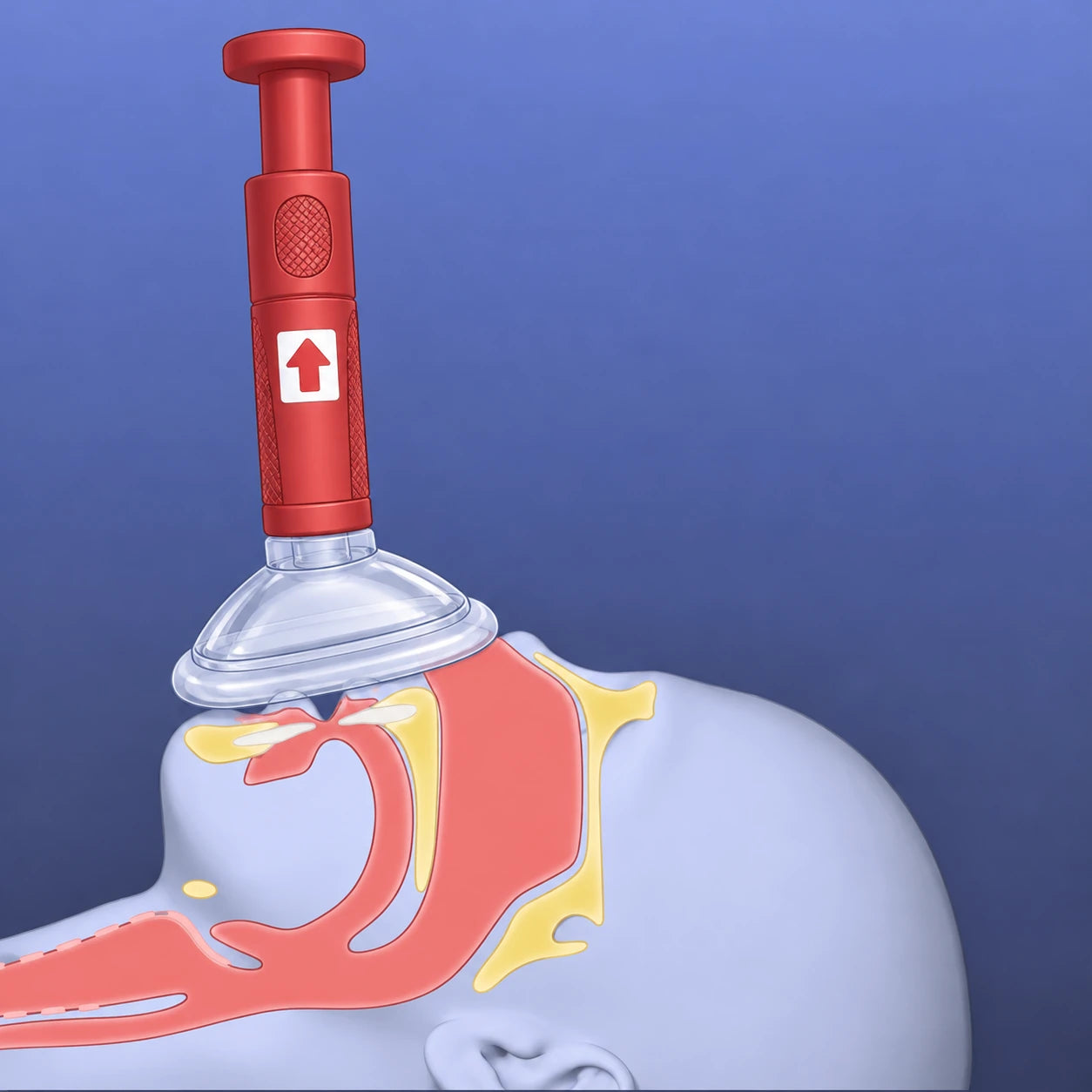 Illustration of the airway with the RescUAid mask sealed over the mouth and nose
